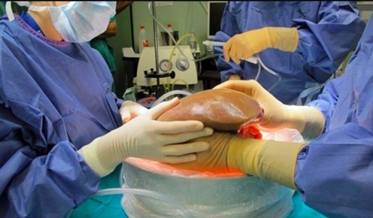 عملية زرع كبد الأولى من نوعها بالمعهد الوطني للأنكولوجيا